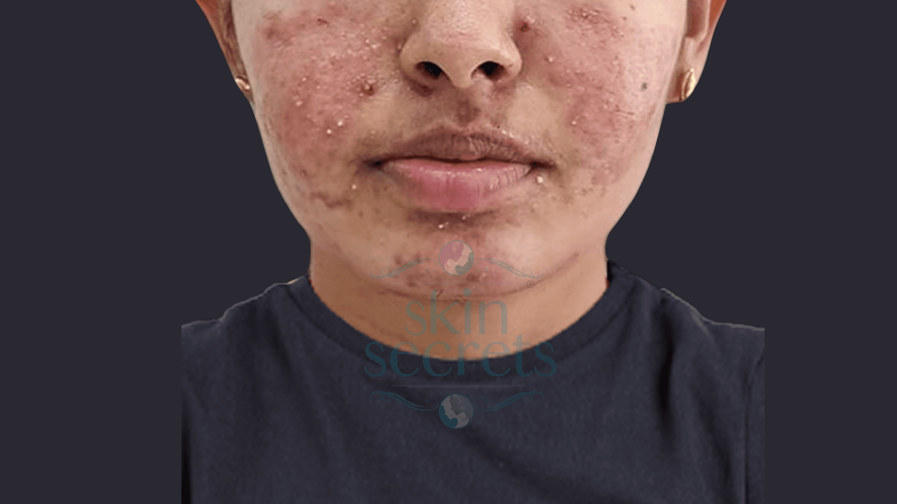 Acne(Pimples)