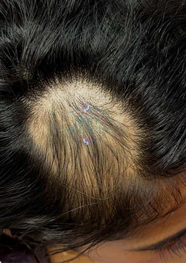 Hair Growth Factors