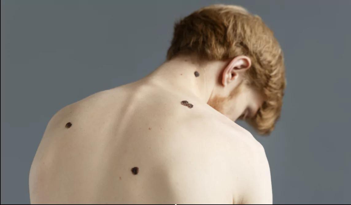 Skin Tags